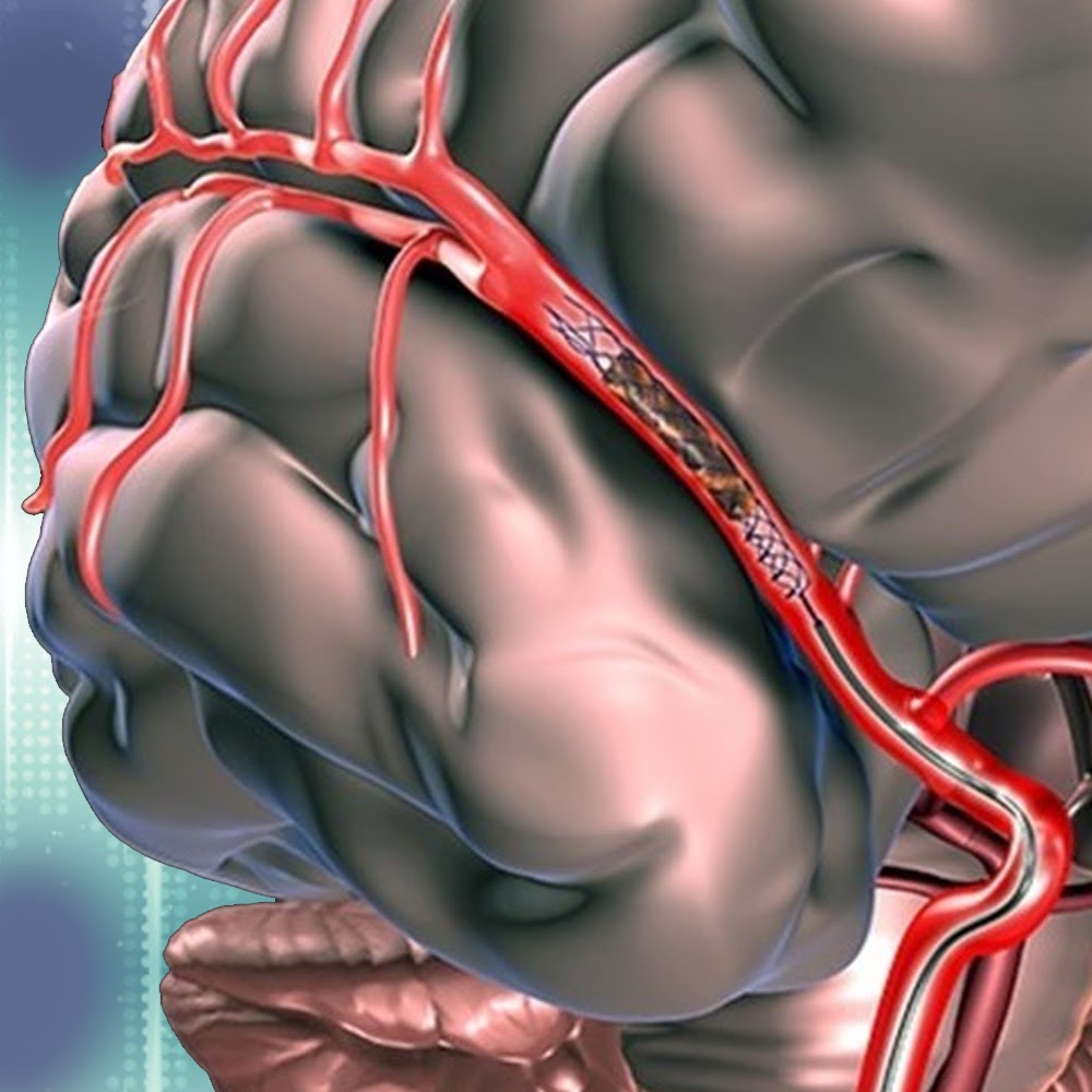 Терапия хронической ишемии мозга на фоне гипертонической болезни: препараты выбора